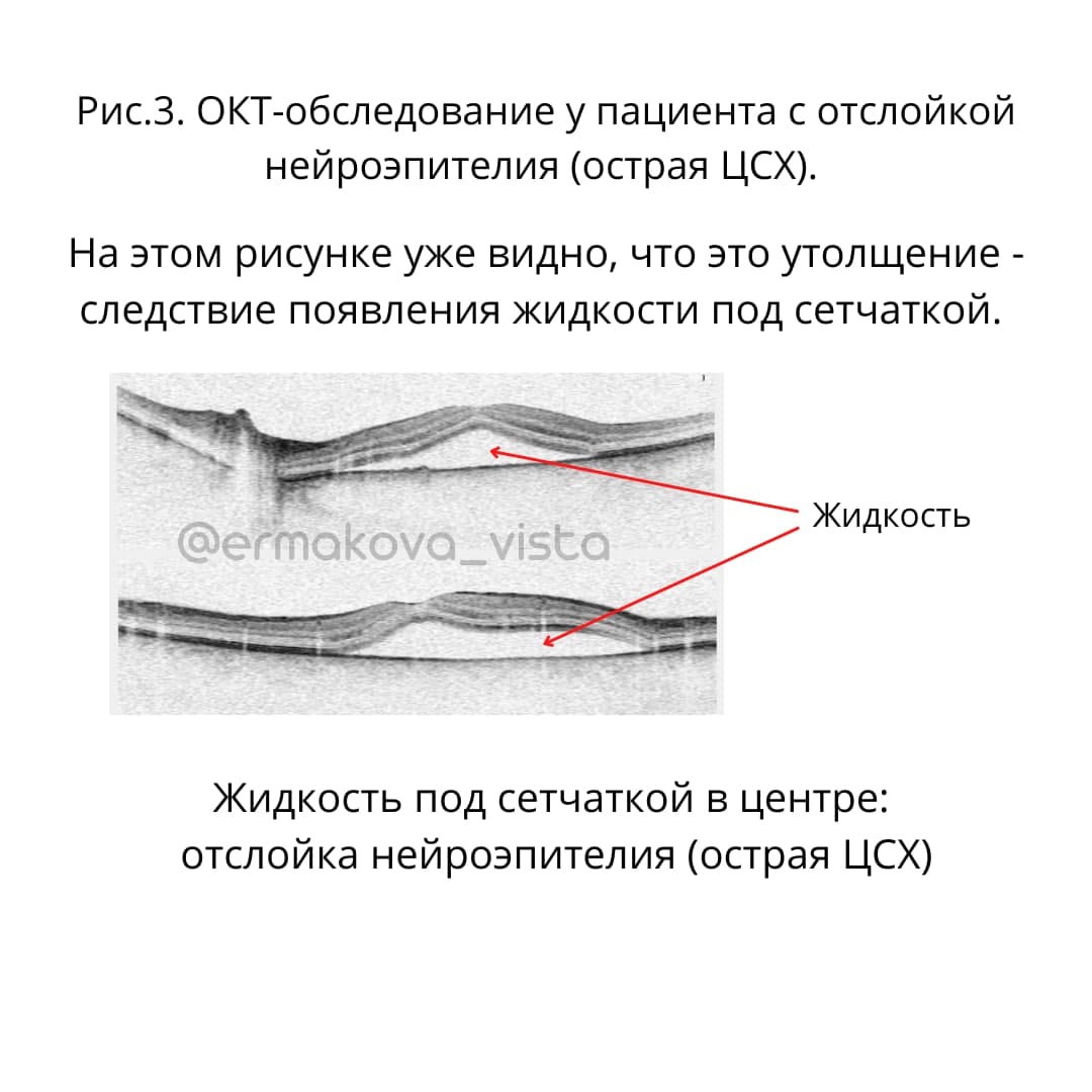 ОКТ обследование отслойка сетчатки