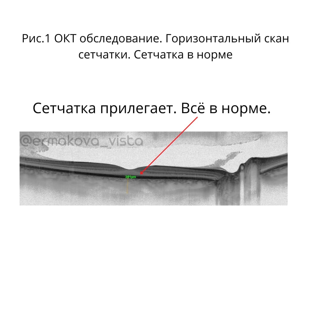 ОКТ обследование сетчатка в норме