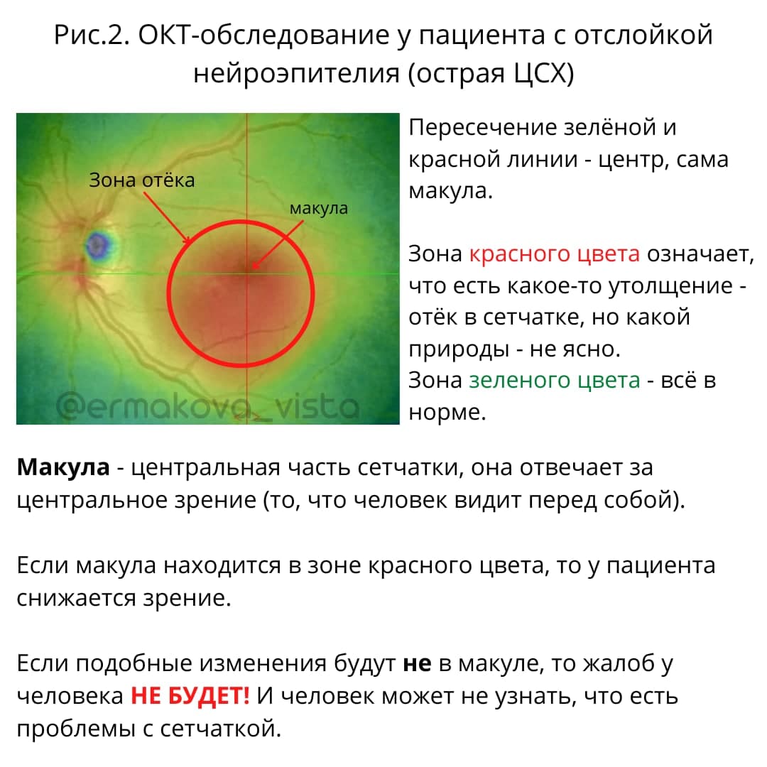 ОКТ обследование отслойка нейроэпителия сетчатки
