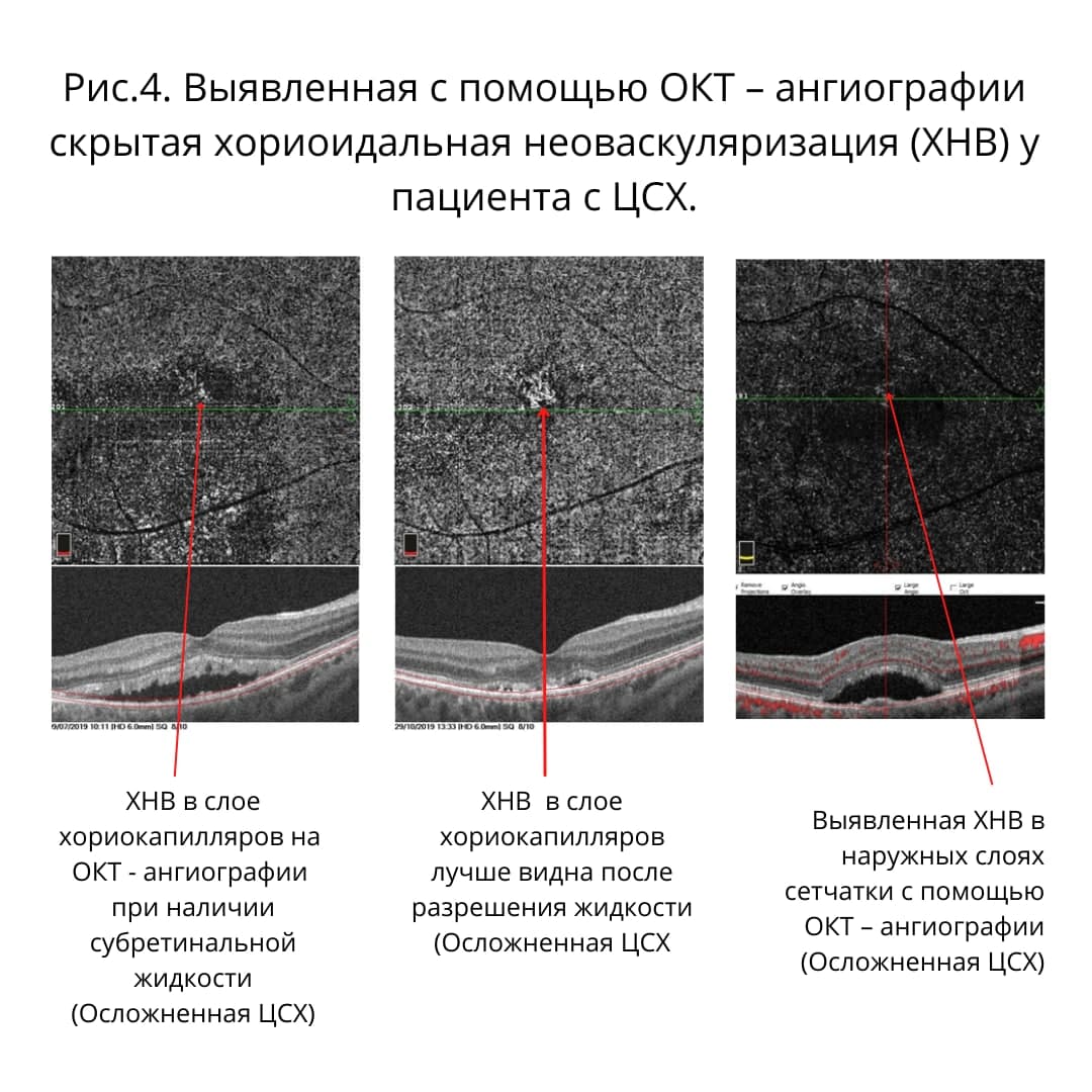 ОКТ обследование выявленная неоваскуляризация ХНВ