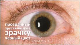 афакичные линзы