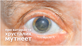 афакичные линзы