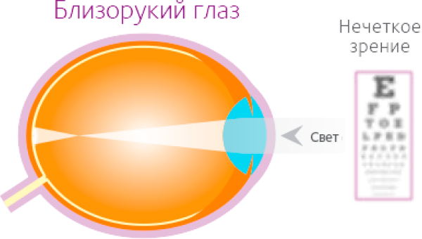 При близорукости изображение рассматриваемого глазом предмета формируется